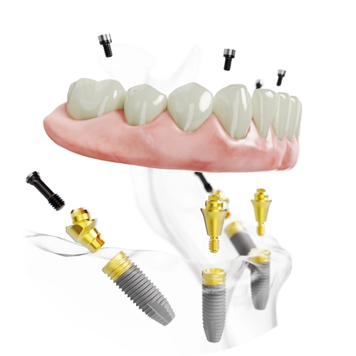 All-on-4 Implantáció